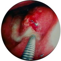 Intragastric fistula with pus exudate.