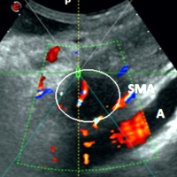 Hypo-echogenic tumor before HIFU ablation