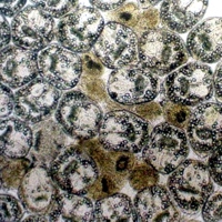 Microscopic photograph of aspirated hydatid fluid showing viable scoliosis