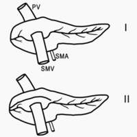 Detail of the schematic representation of the types of portal annular pancreas