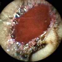 Capsule endoscopy: a pool of fresh blood in the proximal jejunum with no underlying ulcer