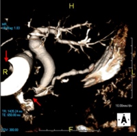 3D MRCP reconstruction