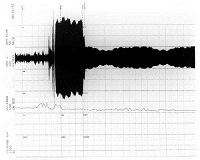 Voiding in a not "relaxed manner" with evidence of pseudodyssynergia