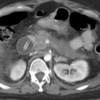 CT scan of abdomen showing replacement gastrostomy tube balloon in the duodenum.