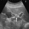 Abdominal ultrasound showing thickened lesion on neck of gallbladder